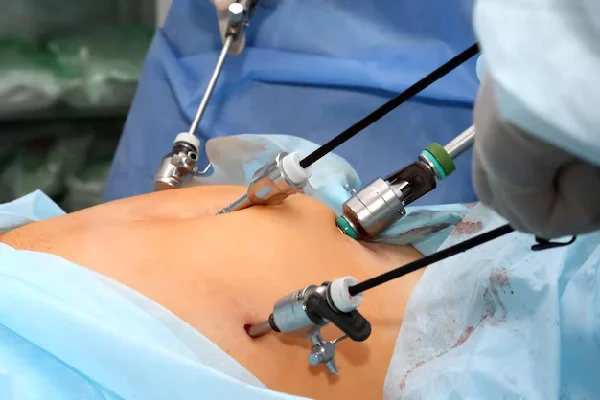 Laparoscopic Hysteropexy