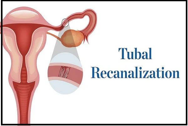 Laparoscopic Recanalization