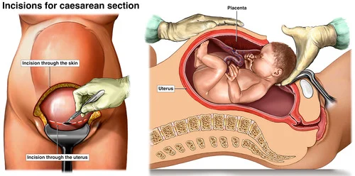 C Section Surgery