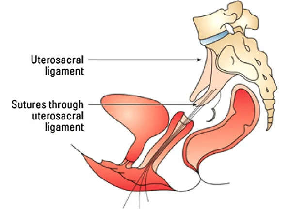 High Uterosacral Suspension