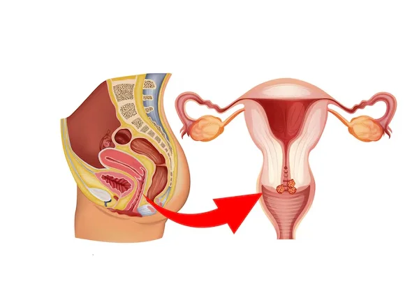 Cervical Cancer